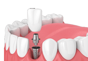 DENTAL IMPLANTS