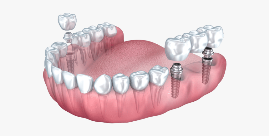 DENTAL IMPLANTS