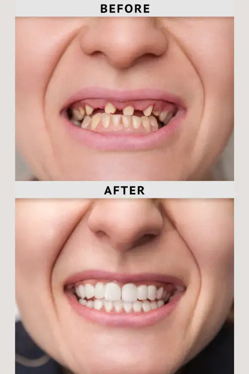 Before and after dental crown treatment