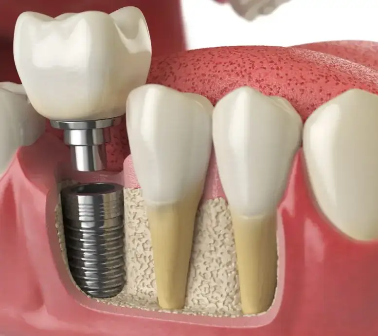 Dental Implants