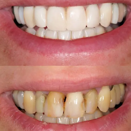 full mouth restoration sherman tx before and after