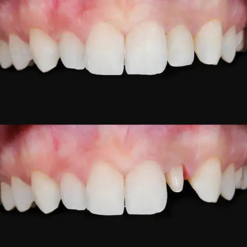 a before and after photo of a crown patient's teeth