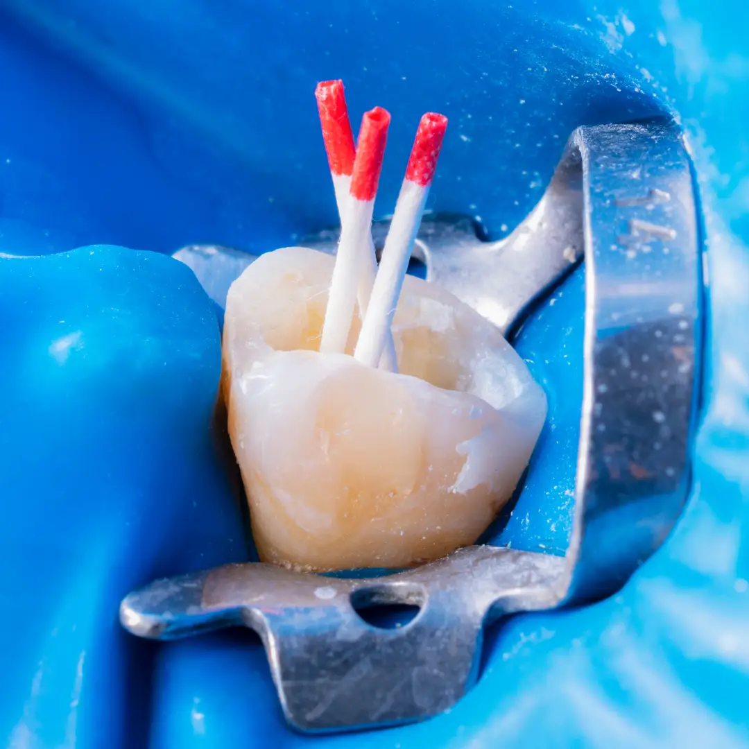 a tooth with toothpicks sticking out of it root canal procedure