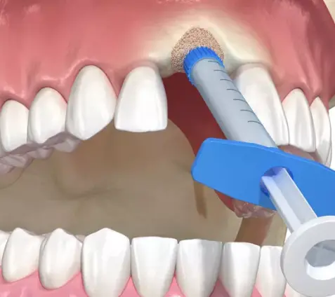 Bone Grafting