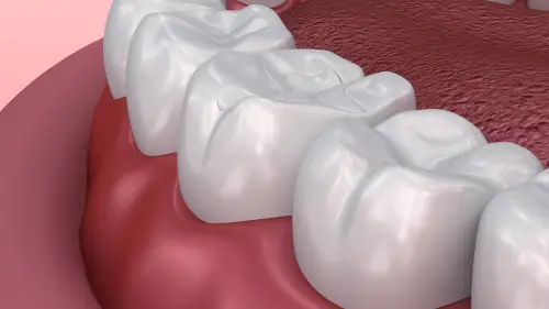  a close up view of a tooth with a dental sealants on it