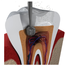 cleaning a root canal