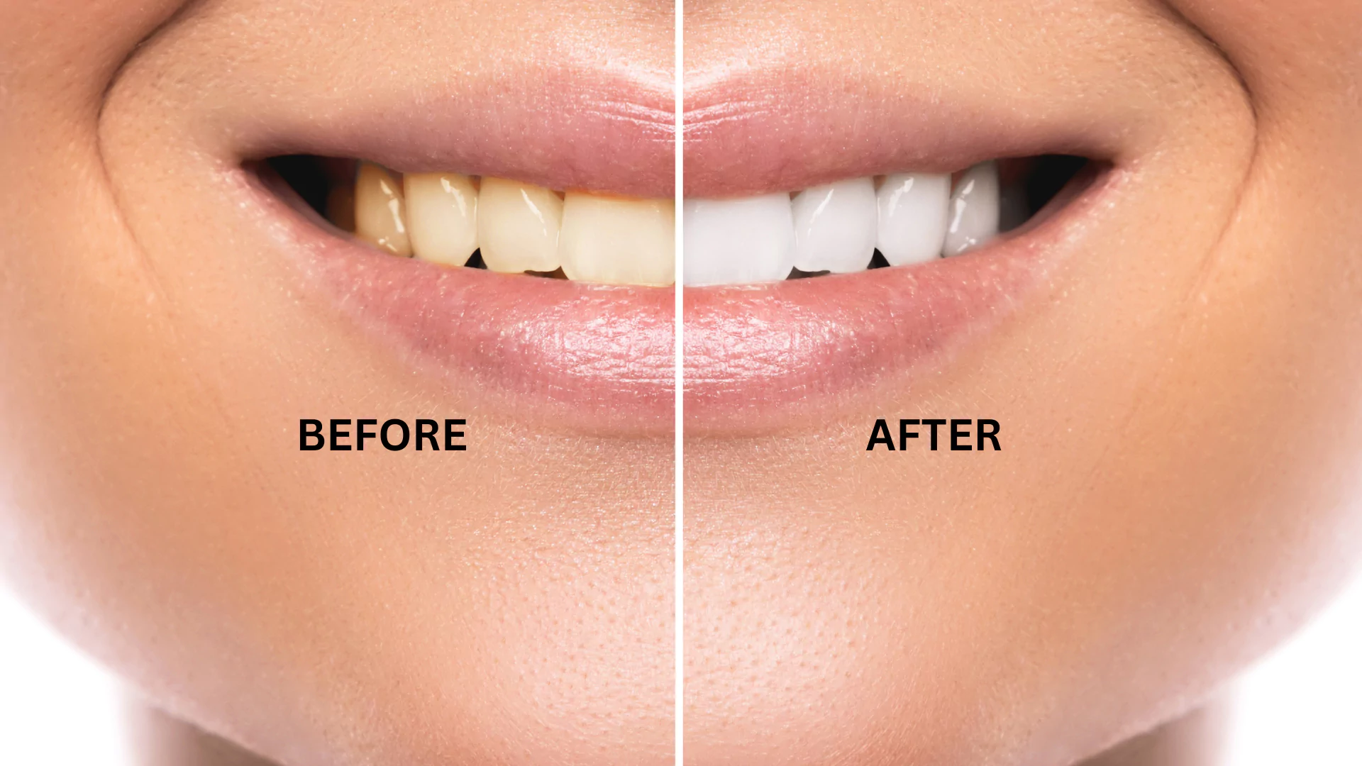 A side-by-side comparison of teeth before and after professional whitening treatment