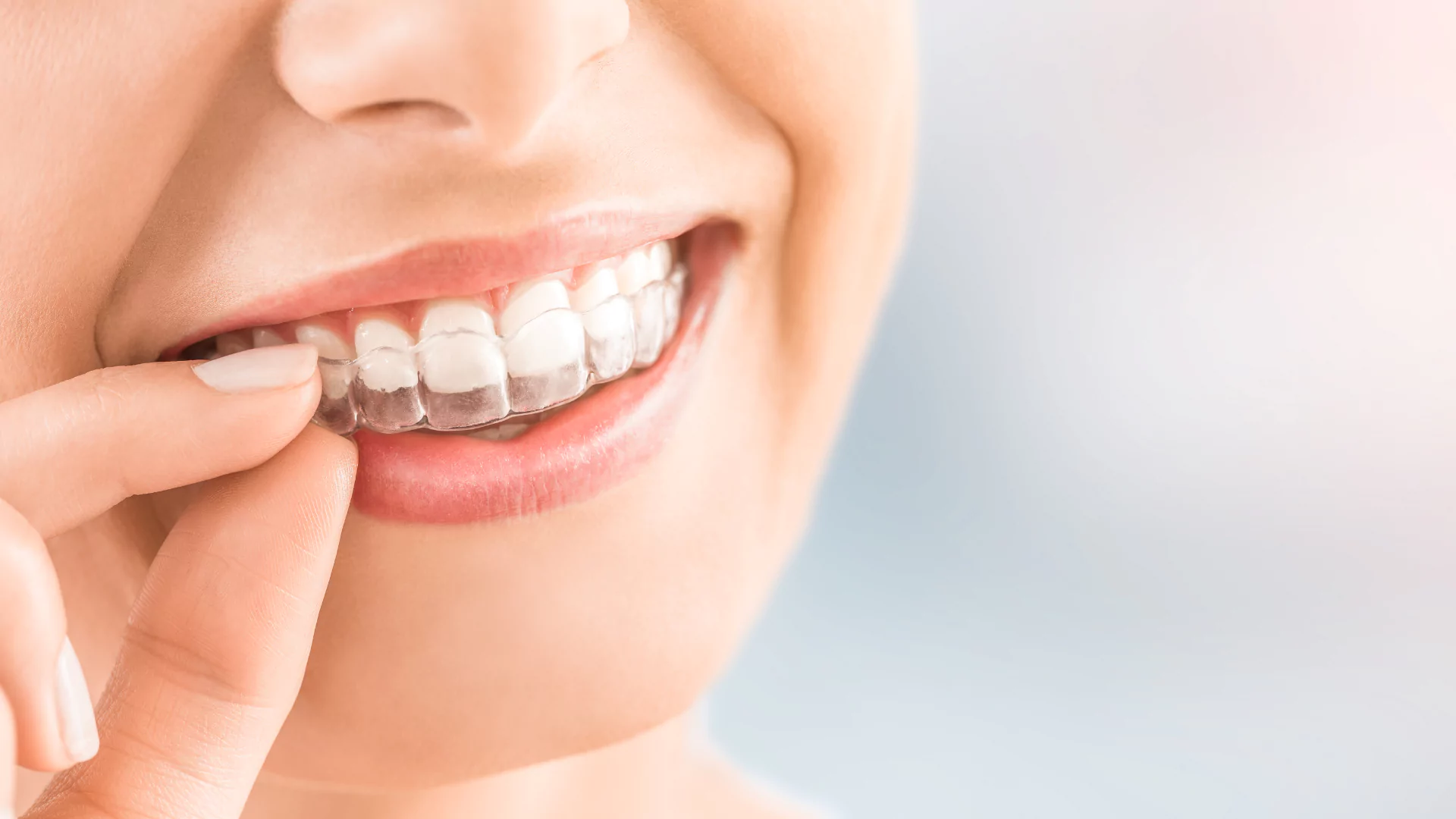 aligners barely noticeable emphasizing their subtle appearance