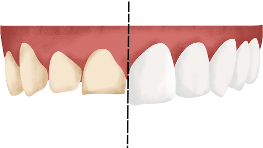 Before and after Veneers