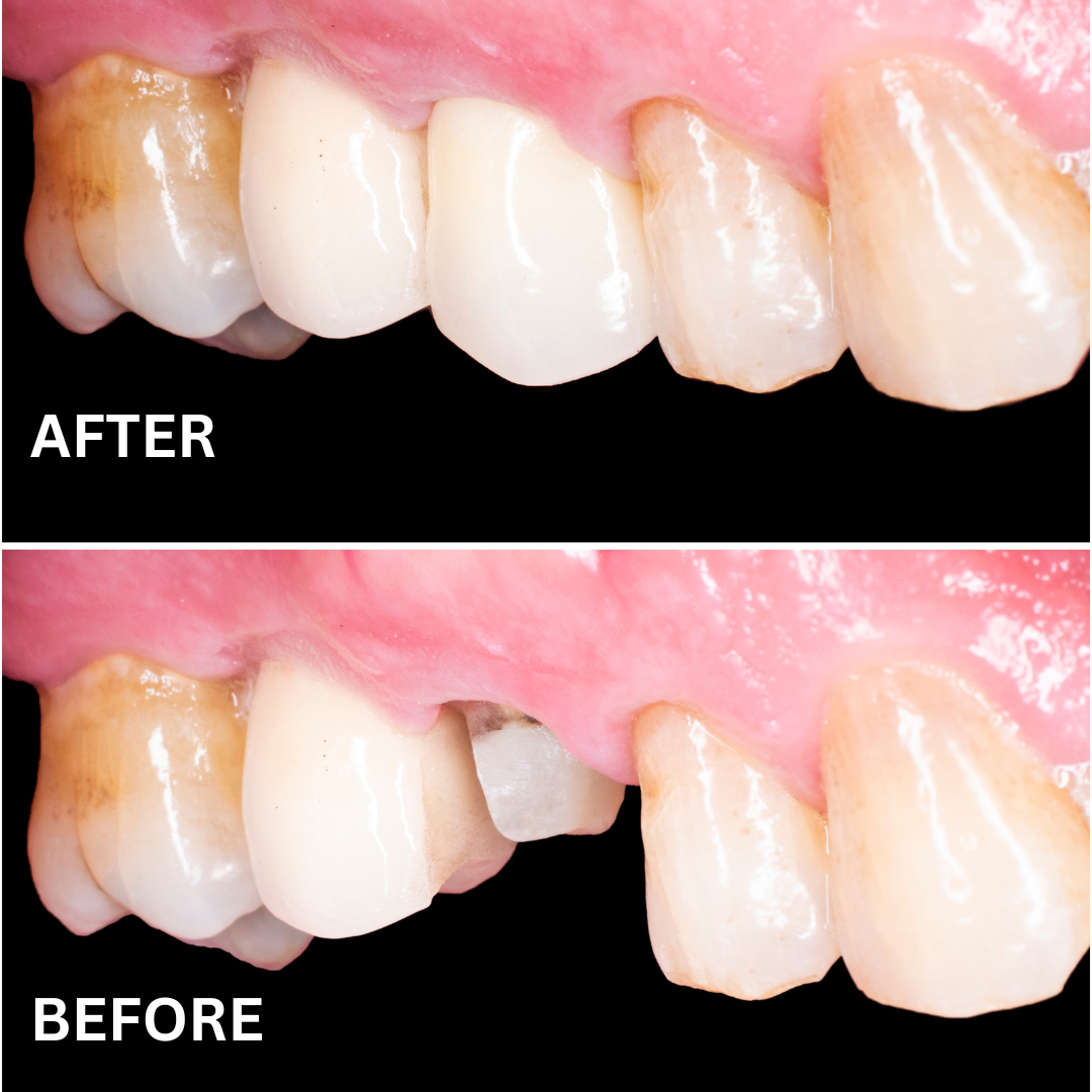 Before and after comparison of a tooth restoration with a dental crown, showcasing improved aesthetics and functionality.