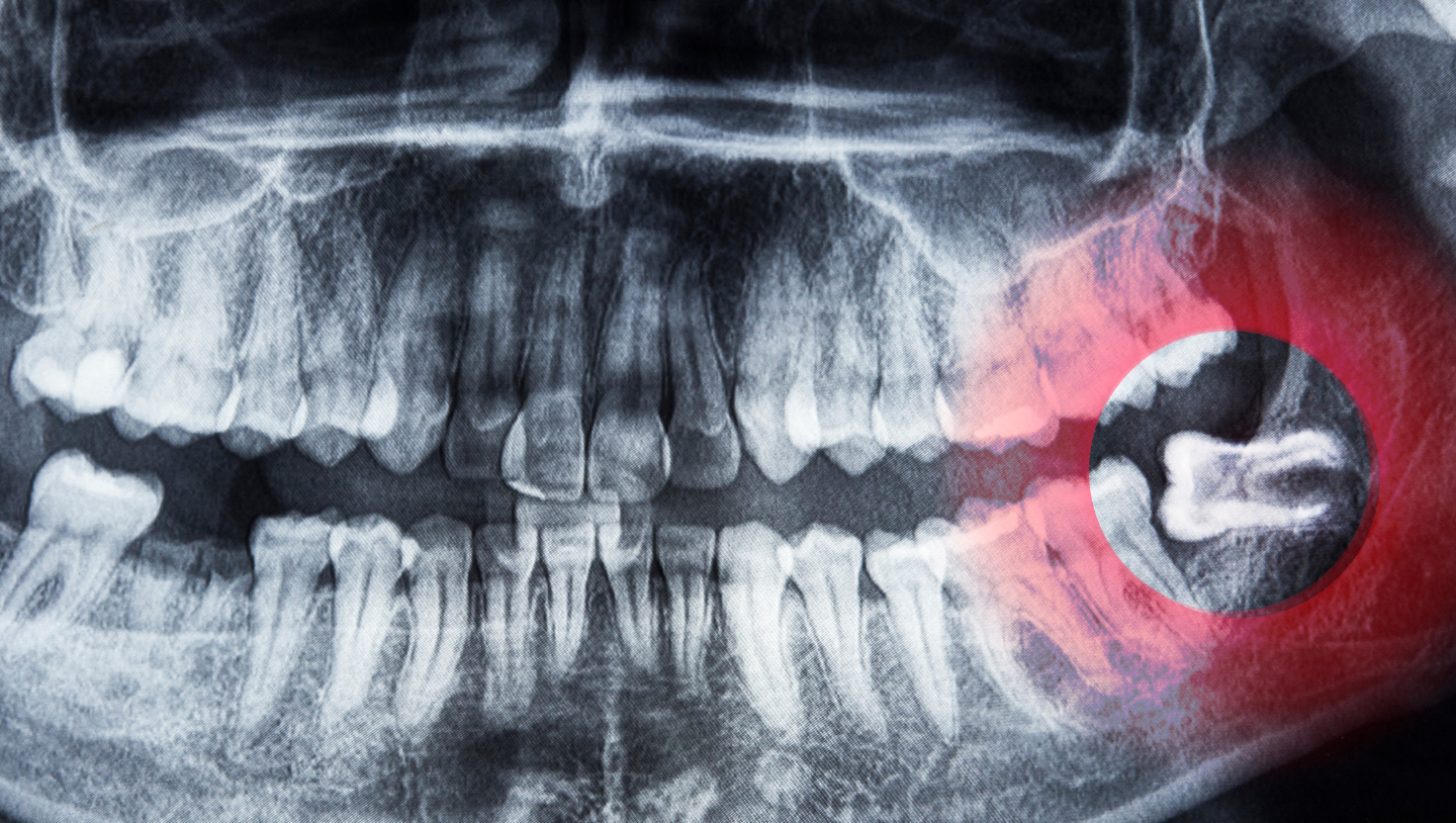 A clear X-ray image showing impacted wisdom teeth 