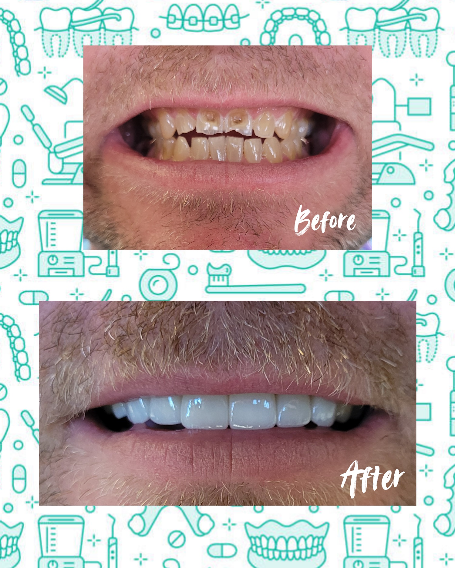 dentalcrowns BEFORE/AFTER Gallery