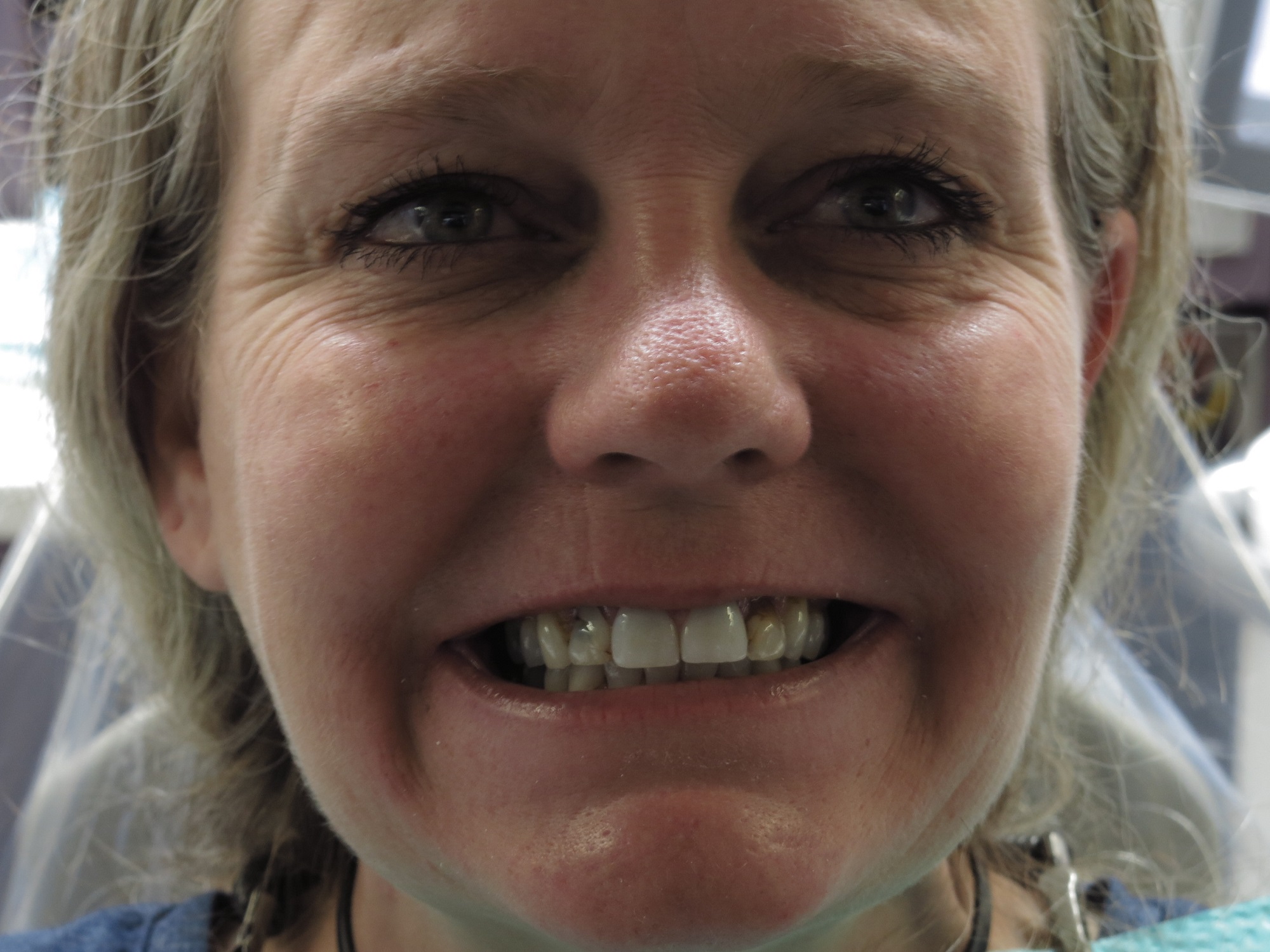 fullmouth1 BEFORE/AFTER Gallery