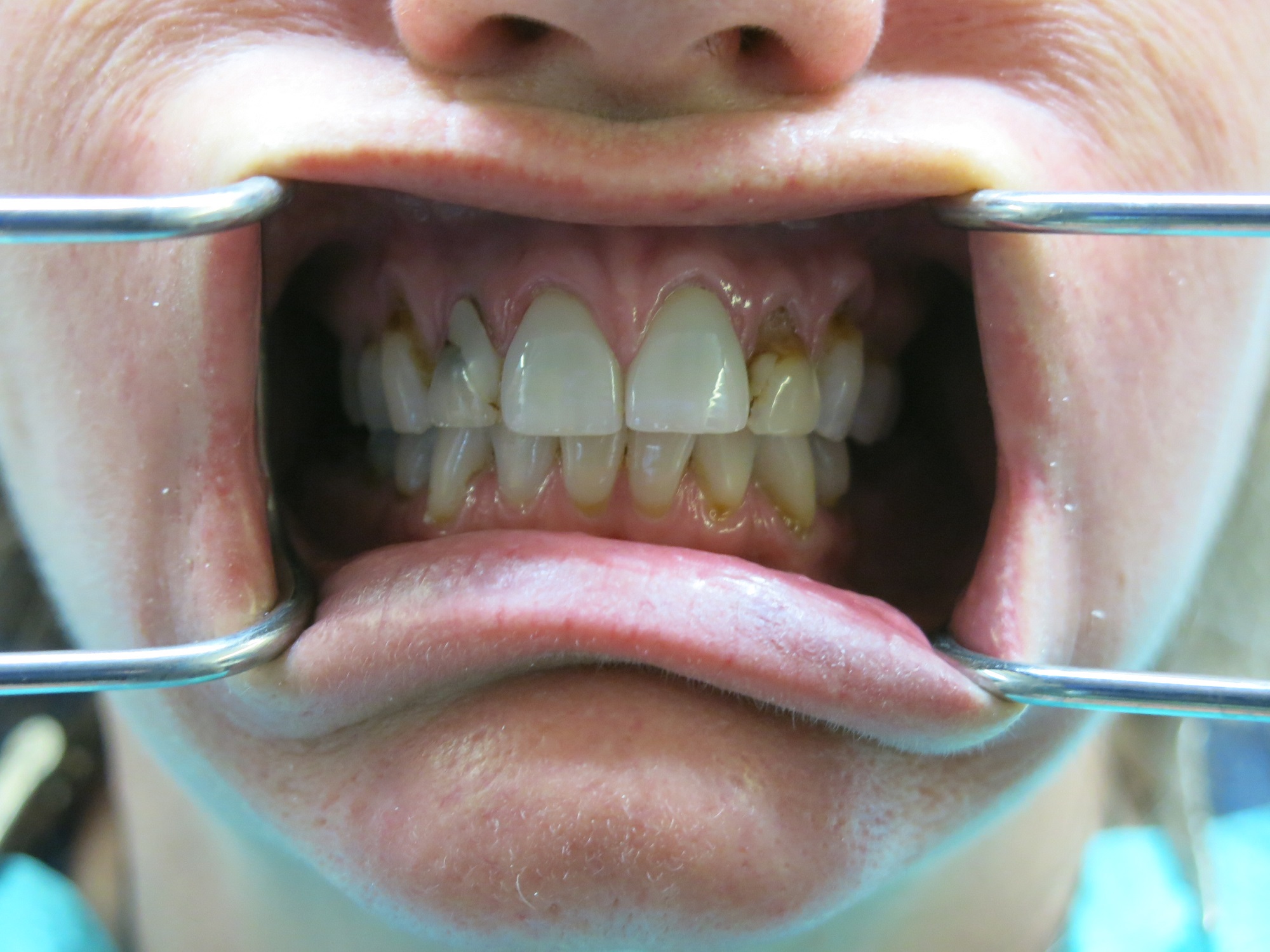 fullmouth3 BEFORE/AFTER Gallery