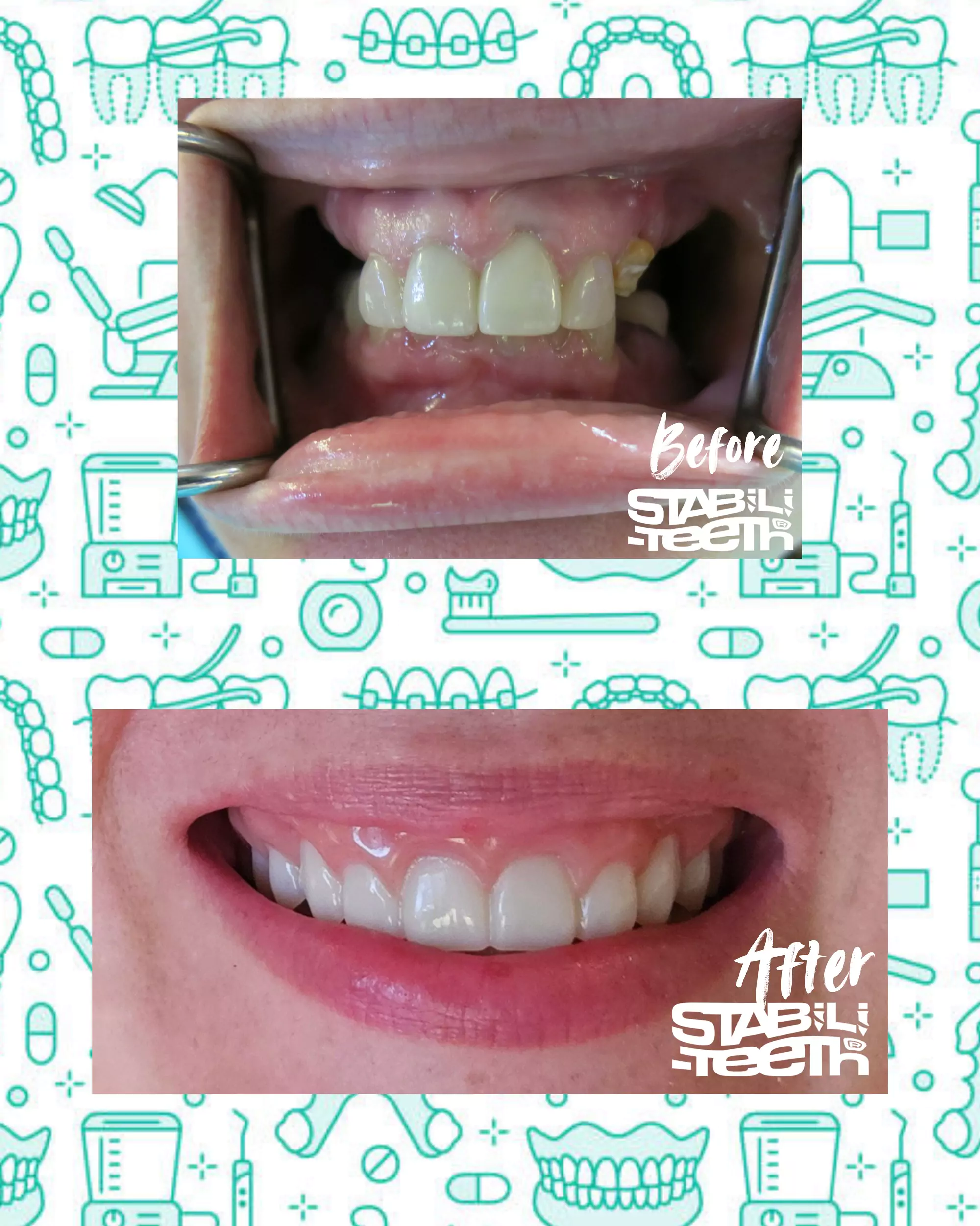 upperarch BEFORE/AFTER Gallery